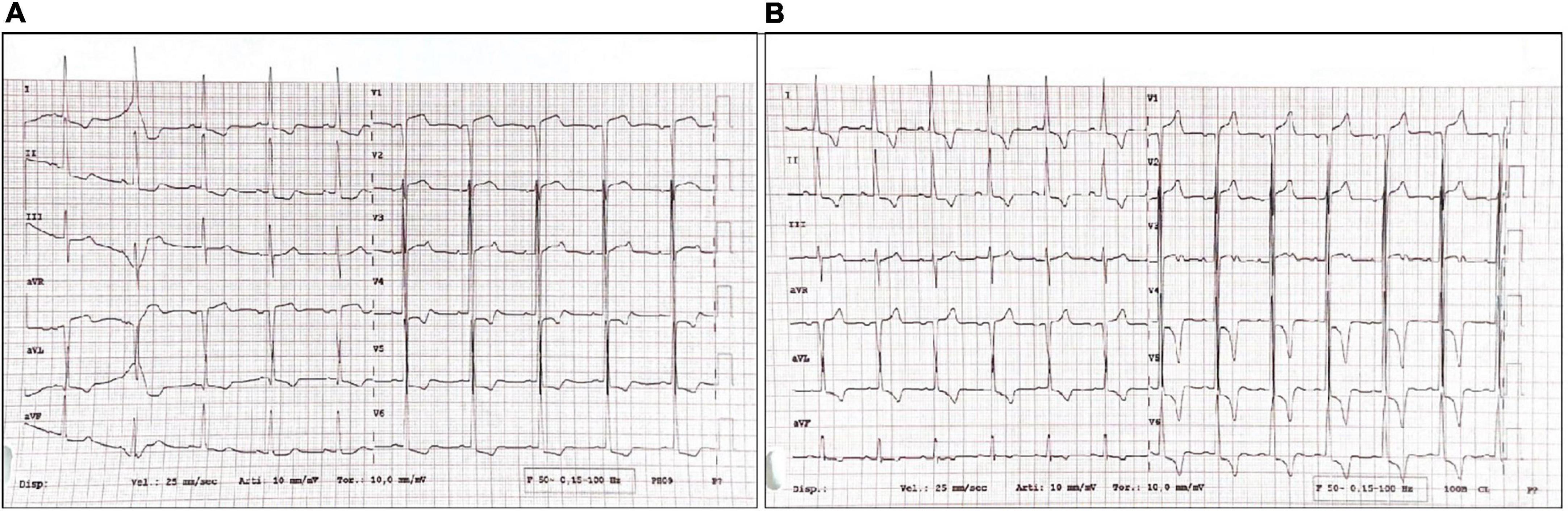 Case report: Area of focus in a case of malignant hypertension